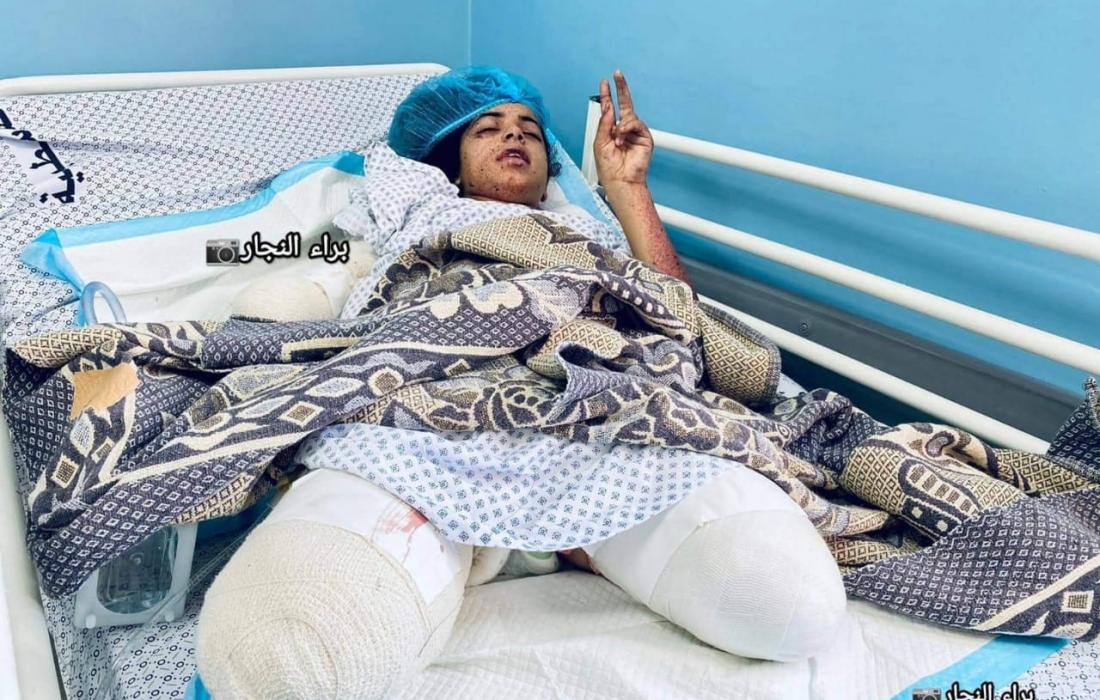 Anak 11 Tahun Kehilangan Tangan dan Kaki Akibat Agresi Israel