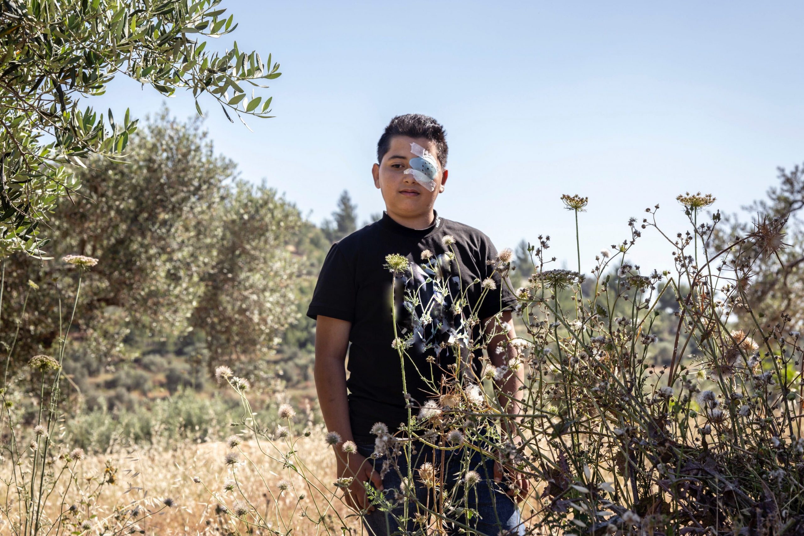 Anak Palestina Kehilangan Matanya Akibat Serangan Israel di Nablus