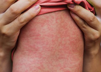 WHO Sebut 40 Juta Anak Terancam Campak