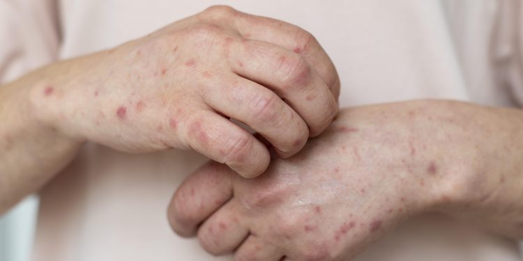 Waspada! Kemenkes Umumkan 55 Daerah KLB Campak di Indonesia