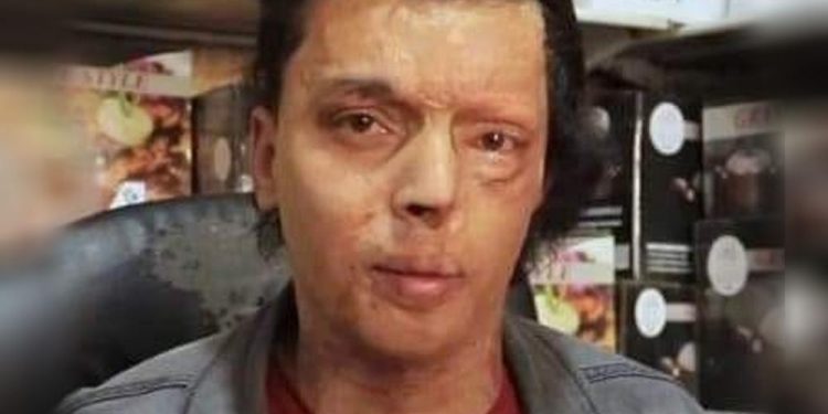 Israel Ledakkan Bom di Dekat Anak Palestina 21 Tahun Lalu, 90 Persen Tubuhnya Menderita Luka Bakar