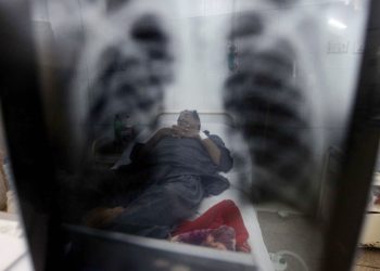 Bahaya! Kasus TBC pada Anak di Bogor Naik Drastis