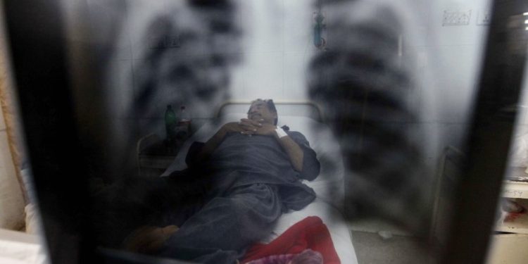 Bahaya! Kasus TBC pada Anak di Bogor Naik Drastis