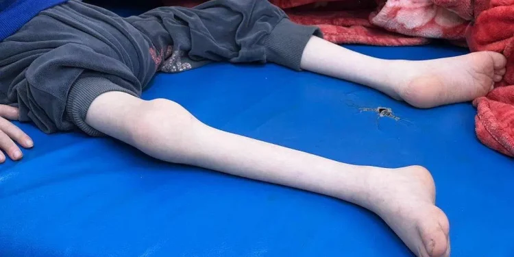 UNICEF Memperingatkan Kematian 23 Anak di Gaza Akibat Kekurangan Gizi Hanyalah 'Puncak Gunung Es'