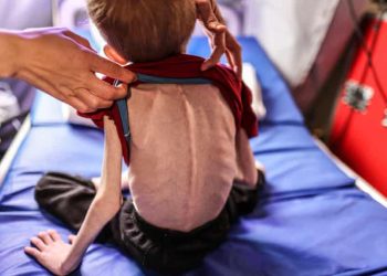 WHO: Hampir 15.000 Anak di Gaza Mengalami Malnutrisi Akut