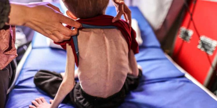 WHO: Hampir 15.000 Anak di Gaza Mengalami Malnutrisi Akut