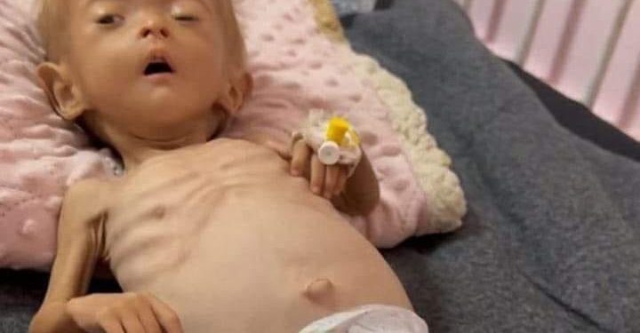 Seorang Gadis Kecil Palestina Menghembuskan Nafas Terakhirnya karena Kekurangan Gizi di Gaza