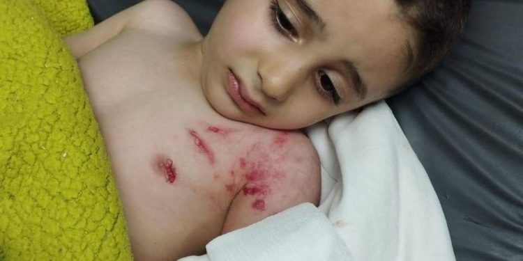 Anak Palestina Usia 3 Tahun Diserang Anjing Tentara Israel