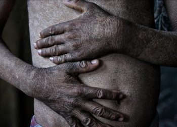 Penyakit Menular, Limbah, hingga Kelaparan Mengintai Pengungsi Gaza