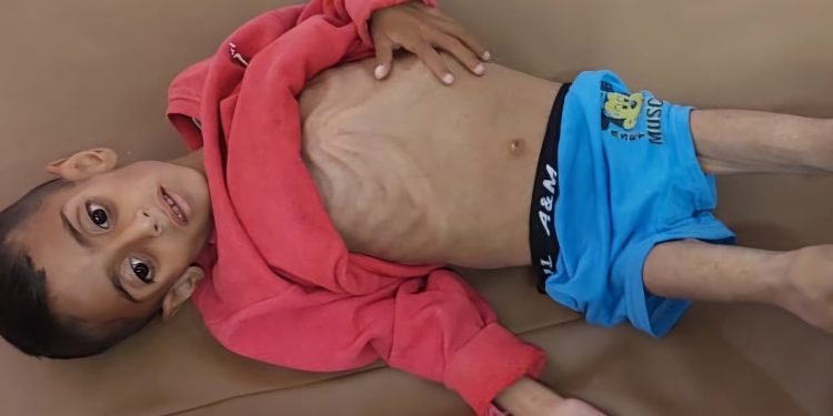 Anak-Anak Gaza di Ambang Malnutrisi Akut: Pengepungan Israel Memicu Bencana Kemanusiaan