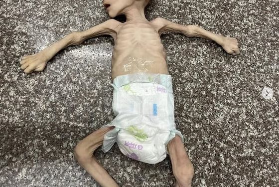 Gaza, Tempat Paling Lapar di Dunia: Anak-anak Meninggal karena Kelaparan, Sistem Kesehatan Runtuh