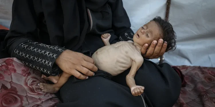 Bayi Palestina berusia lima bulan, Ammar Ammara, menderita malnutrisi parah di Kota Gaza, Gaza, akibat blokade dan serangan Israel yang terus berlangsung, 7 Agustus 2025. [Khames Alrefi – Anadolu Agency]