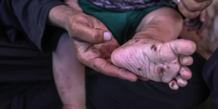 Krisis Kemanusiaan di Gaza: Bayi Kehabisan Obat dan Susu, Kulit Membusuk di Tengah Kelaparan akibat Agresi Israel