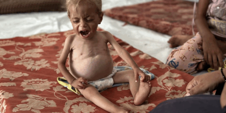 112 Anak Gaza Meninggal, Kelaparan Buatan Israel Picu Krisis Malnutrisi Balita