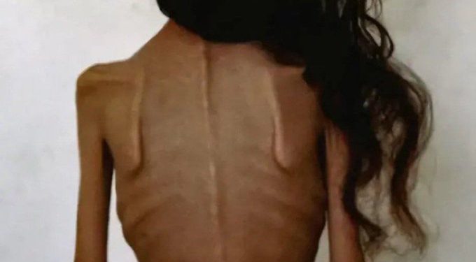 Krisis Kelaparan Makin Parah di Gaza, Korban Jiwa Terus Bertambah