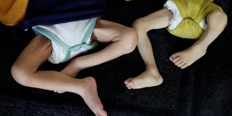 UNICEF: 1 dari 5 Anak di Gaza Menderita Malnutrisi Akut