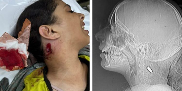 Dokter Asing Ungkap Pola Mengkhawatirkan Pasukan Israel yang Menargetkan Anak-anak di Gaza