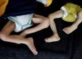 Potret kaki dua bayi di Gaza yang menderita malnutrisi (Reuters)