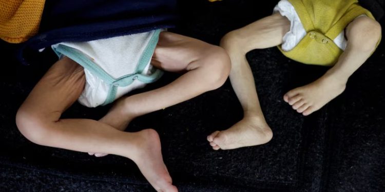 Potret kaki dua bayi di Gaza yang menderita malnutrisi (Reuters)
