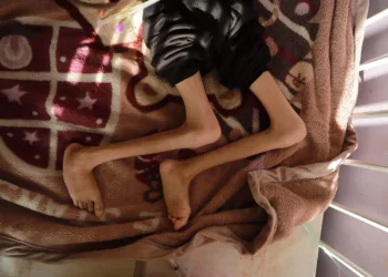 Gadis Palestina berusia 7 tahun, Amire Muhammad al-Hawajiri, dirawat dengan sumber daya terbatas di Rumah Sakit Syuhada Al-Aqsa di Deir al-Balah, Gaza pada 20 November 2025. [Khalil Ramzi Alkahlut – Anadolu Agency]