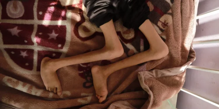 Gadis Palestina berusia 7 tahun, Amire Muhammad al-Hawajiri, dirawat dengan sumber daya terbatas di Rumah Sakit Syuhada Al-Aqsa di Deir al-Balah, Gaza pada 20 November 2025. [Khalil Ramzi Alkahlut – Anadolu Agency]