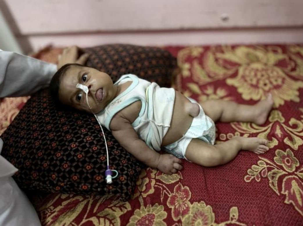 Jannah Mteir, bayi berusia dua bulan, berjuang melawan penyakit langka di tengah perang dan pengepungan (8/11). Ia lahir prematur dengan sindrom Beckwith-Wiedemann, kondisi genetik langka yang menyebabkan pembesaran organ dalam dan lidah, lubang di jantung, hernia umbilikalis, serta pembesaran sisi kiri tubuhnya dan penurunan kadar gula darah yang drastis. Genosida Israel di Gaza serta pembatasan makanan dan pasokan medis yang terus berlanjut, menyebabkan kondisinya semakin memburuk. (Doaa Albaz/ActiveStill)