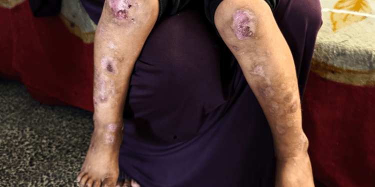 Pasien Kanker di Gaza Terjebak di Antara Genosida dan Blokade