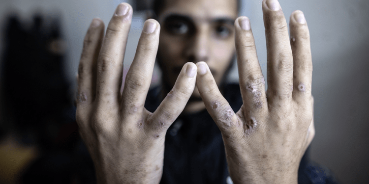 Pembebasan Tawanan Tidak Mengakhiri Penderitaan Mereka