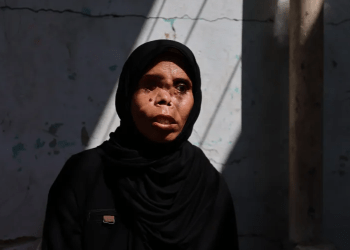 Jalan Panjang Pemulihan Ibu Gaza yang Kehilangan Mata dan Putrinya